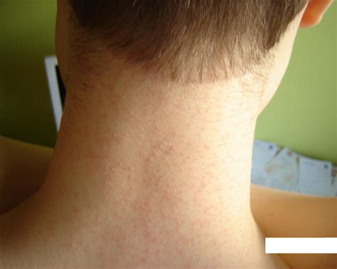Malassezia Pityrosporum Folliculitis Treatment 4
