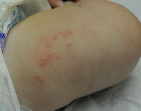 Herpes (HSV) | School of Medicine
