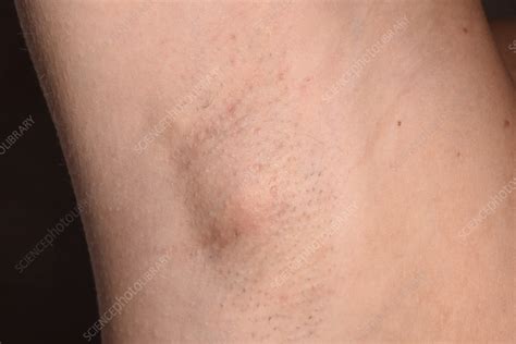 Swollen Lymph Nodes In Armpit: Symptoms, Causes, And, 53% OFF