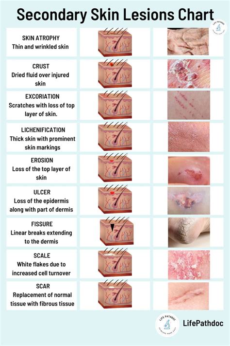Skin Lesions: Types with Chart, Pictures, Causes, Treatment