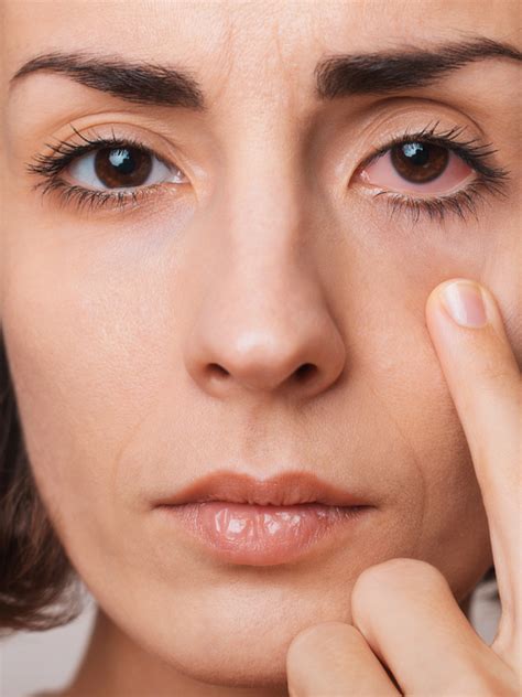 Ocular Surface Disease - Island Eyecare
