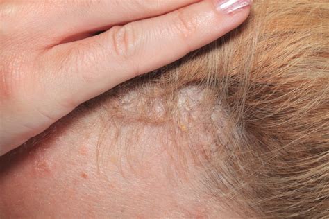 Scalp psoriasis: Symptoms, causes, and treatment
