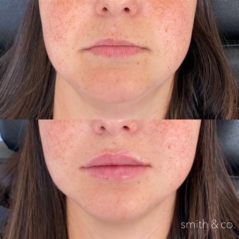 lips — Miami Beach Botox Specialist