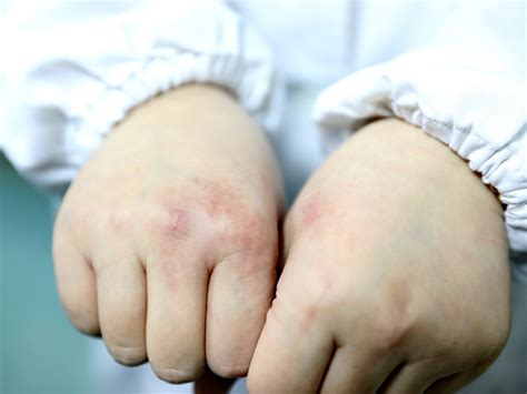 Это простое народное средство поможет навсегда забыть об аллергии