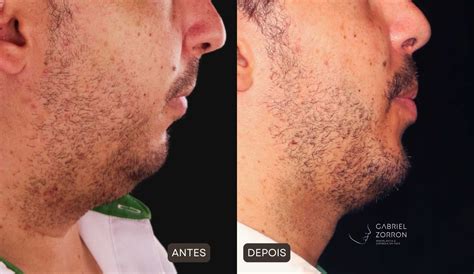 Cirurgias Ortognaticas Antes E Depois - Cirurgia ortognática: antes e depois | Dr. Gabriel Zorron