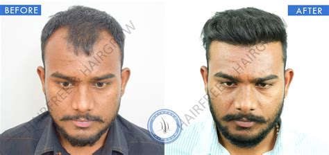 Before and After Hair Transplant Results: Transformative Outcomes