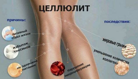 Пять правил избавления от целлюлита в домашних условиях Целлюлит ...