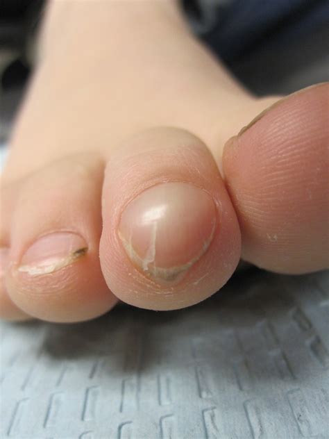 Glomus Tumor Toe