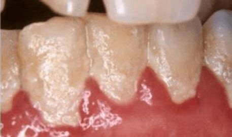 plak gigi definisi mekanisme faktor komposisi pembentukan