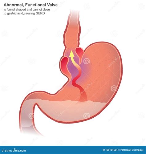 Gastroesophageal Reflux Disease Stock Photography | CartoonDealer.com
