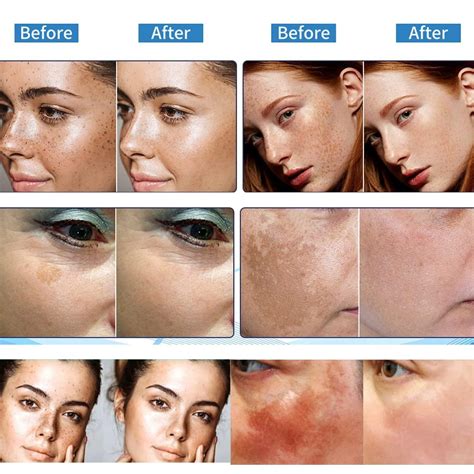 Dark Spot Remover for Face | Hyperpigmentation & Melasma Treatment ...