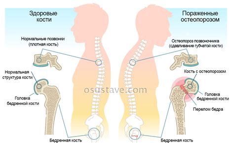 Все признаки и симптомы остеопороза, боли, полный обзор