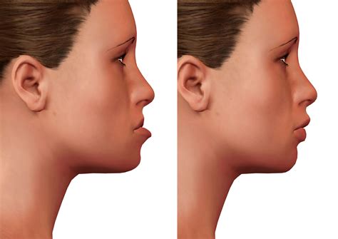 O Que É Ortognática - O que é a cirurgia ortognática e para quem é indicada? | BOA FORMA