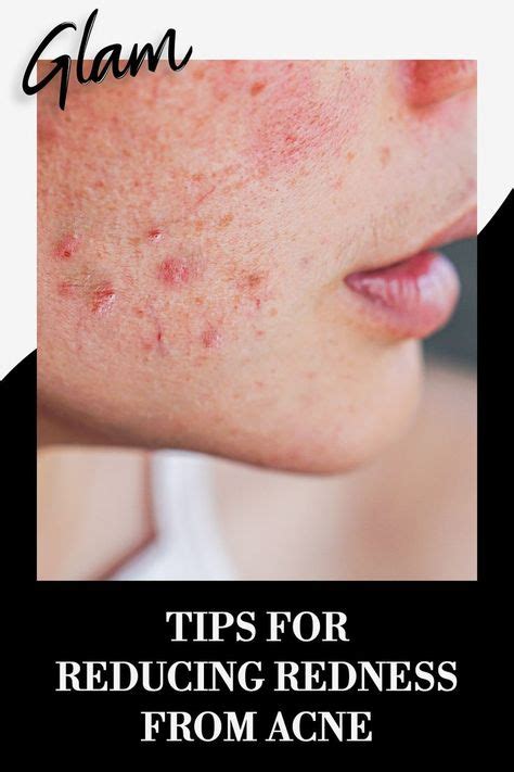 Effective Home Remedy to Reduce Redness from Popped Acne Without Irritation - Hunter Games Magazine