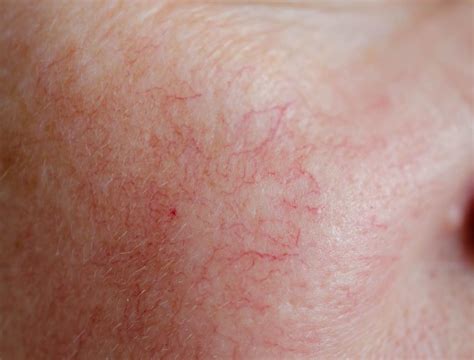 broken blood vessels dermatologist   vrogueco