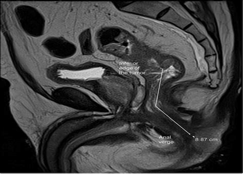 Comparison of flexible endoscopy and magnetic resonance imaging in