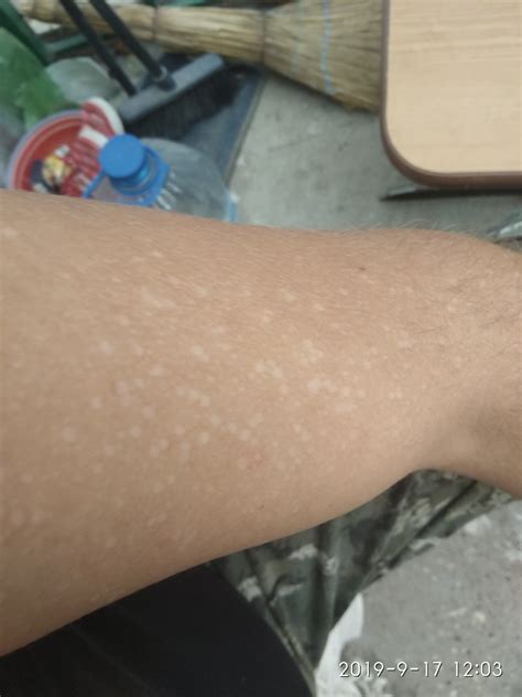 Белые пятна на лице Появились белые пятна во круг родинки прям на лице ...