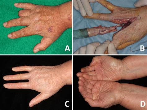 Melanoma Under Nail Treatment - My Bios