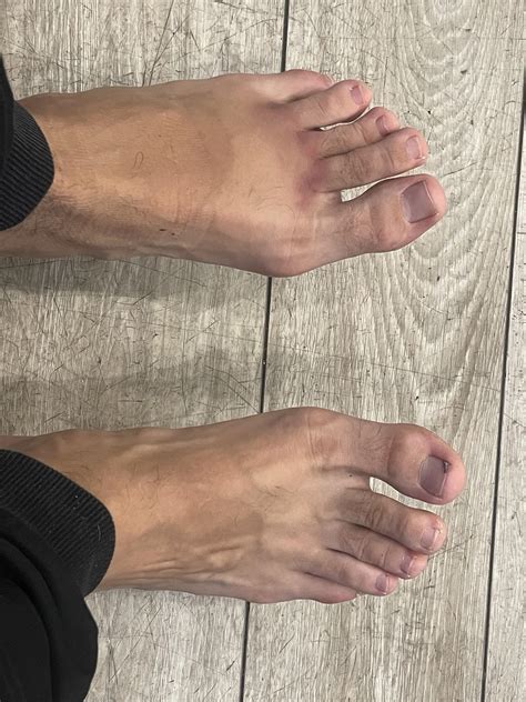Broken toe? : r/medical_advice