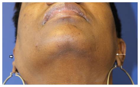 Mikulicz Disease