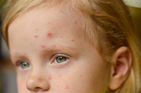 Marcas De Varíola No Rosto - Varíola de macaco: como funciona a transmissão e saiba se prevenir | HZ