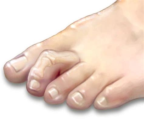 Народное лечение больных суставов желатином | Hammer toe correction ...