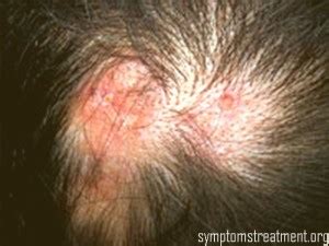 Discoid Lupus- Pictures, Symptoms, Treatment, Photos