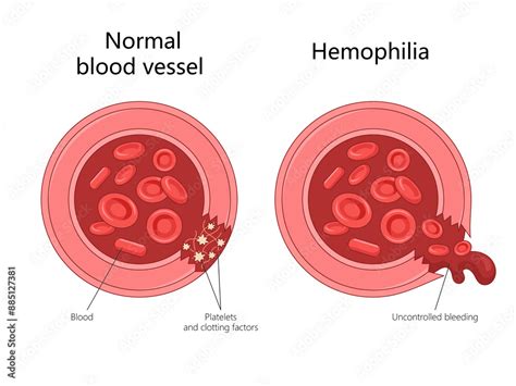 comparing  normal blood vessel   affected  hemophilia