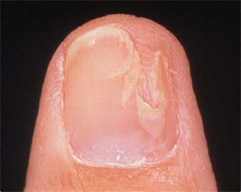 Posttraumatic Split Nails | Musculoskeletal Key