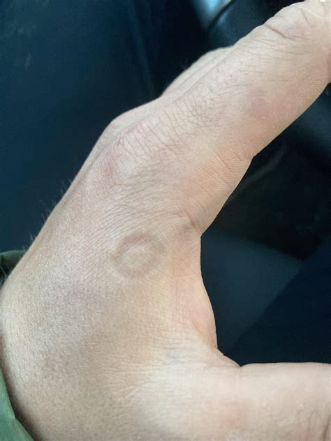 Weird ring indentation : r/DermatologyQuestions