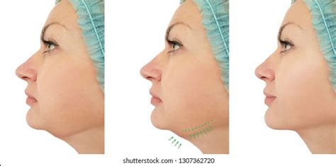 Woman Chin Lift Before After Procedures Stock Photo (Edit Now) 1307362720
