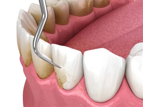 oral hygiene scaling root planing conventional periodontal therapy