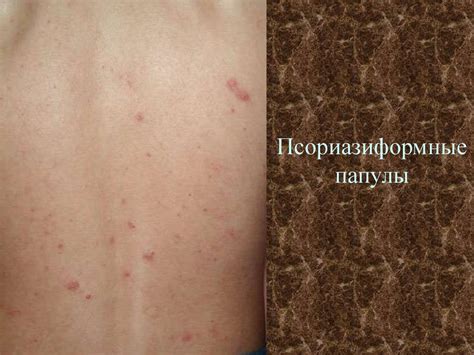 Вторичный период сифилиса - презентация онлайн