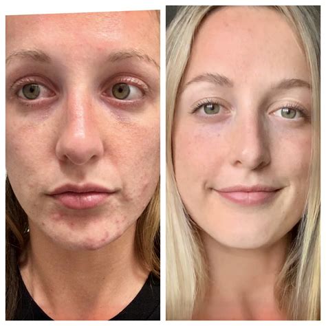 Is My Makeup Causing Cystic Acne | Saubhaya Makeup