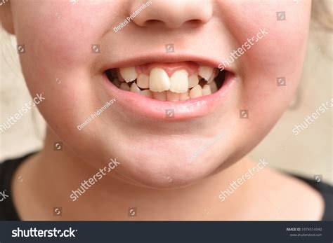 3,259 Crooked Teeth Girl Images, Stock Photos & Vectors | Shutterstock