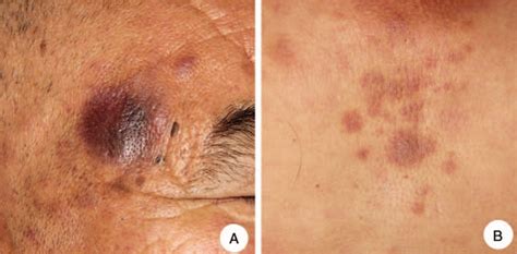 Blastic Plasmacytoid Dendritic Cell Neoplasm: A Case Report ...