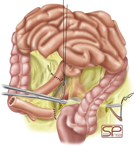 ileal conduit urinary diversion bag gtubm
