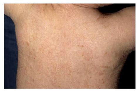 Pediatric mastocytosis: routine anesthetic management for a complex ...