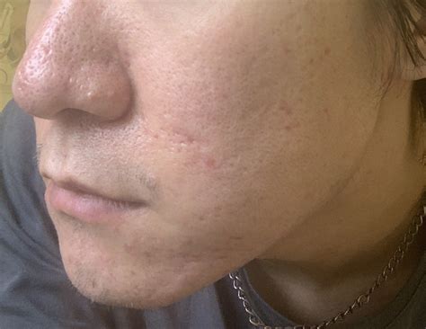 Phenol Peel? Scar pics - Scar treatments - Acne.org
