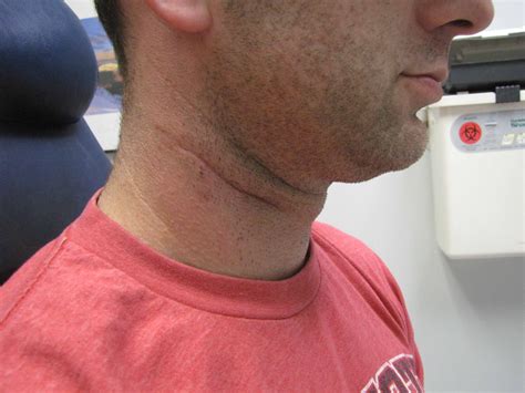 Congenital Branchial Cleft Cyst 8