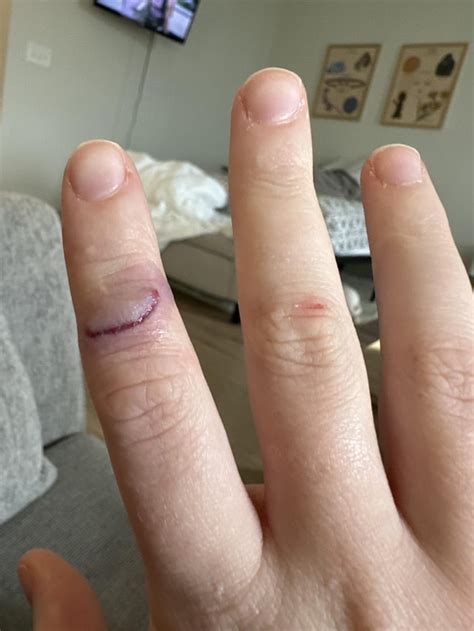 Finger scar healing : r/scars