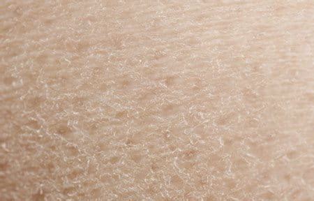 Eucerin: Dry skin | How to deal with dry body skin