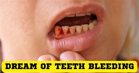 dream  teeth bleeding     signify