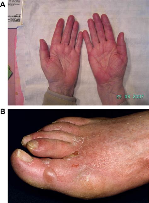 hand foot syndrome sickle cell  jane mcgary blog