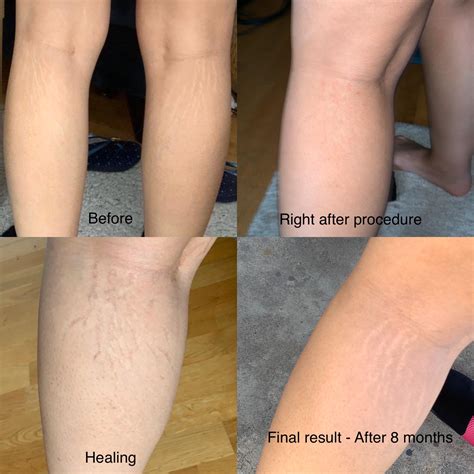 hiding stretch marks with tattoo 10