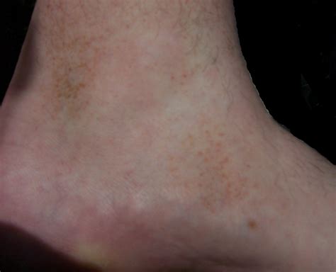 Schamberg's Disease: Causes, Symptoms and Treatment