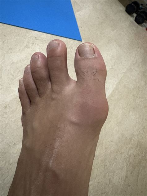 The Dead Rabbit's Lair: First Gout Attack Of 2025