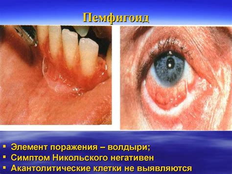 Пародонтит у детей. Этиология, патогенез, клиника, диагностика ...