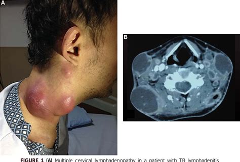 Figure 1 from Tuberculous Lymphadenitis and Parotitis. | Semantic Scholar