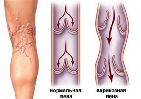 Диета при варикозе нижних конечностей: особенности и правила питания